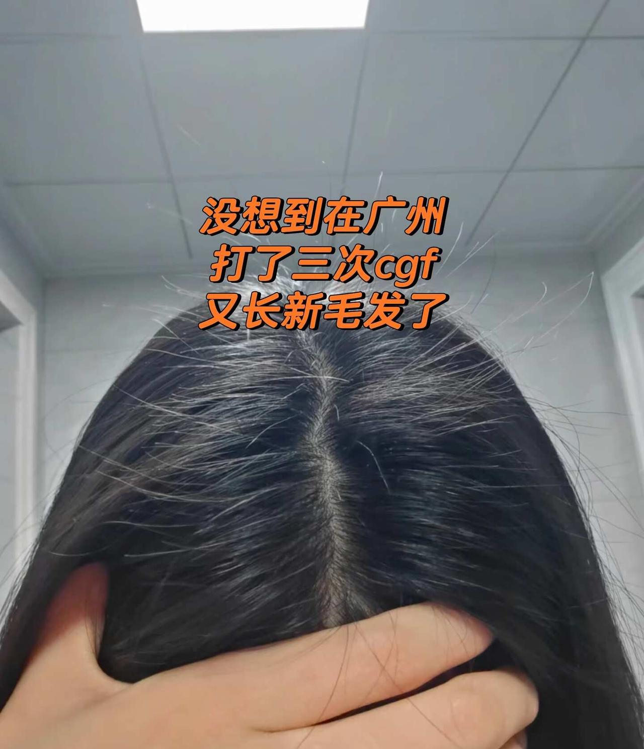 在广州记录我的生发历程
现在发缝长出很多头发，真的不用再担心了我长头发了 广州 