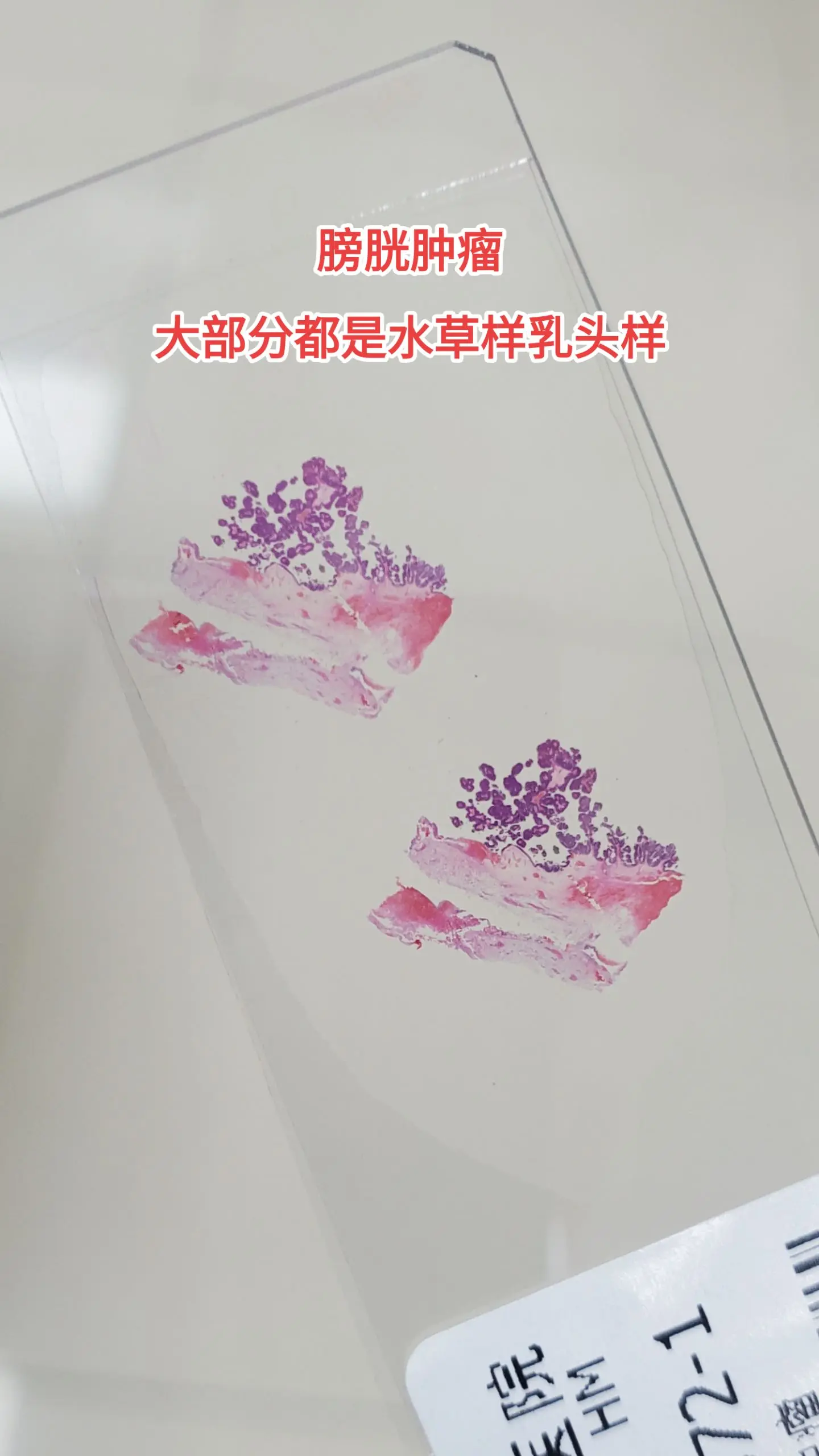 膀胱低级别乳头状非浸润性尿路上皮癌