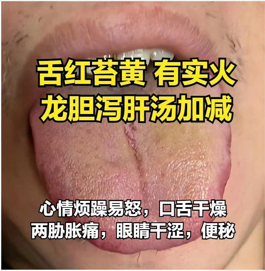 肝火旺，用龙胆泻肝没有效果，关键在于分清虚火还是实火今天教大家通过舌象区分，对症