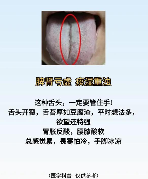 2 种裂纹舌象，对照自查脏腑虚实