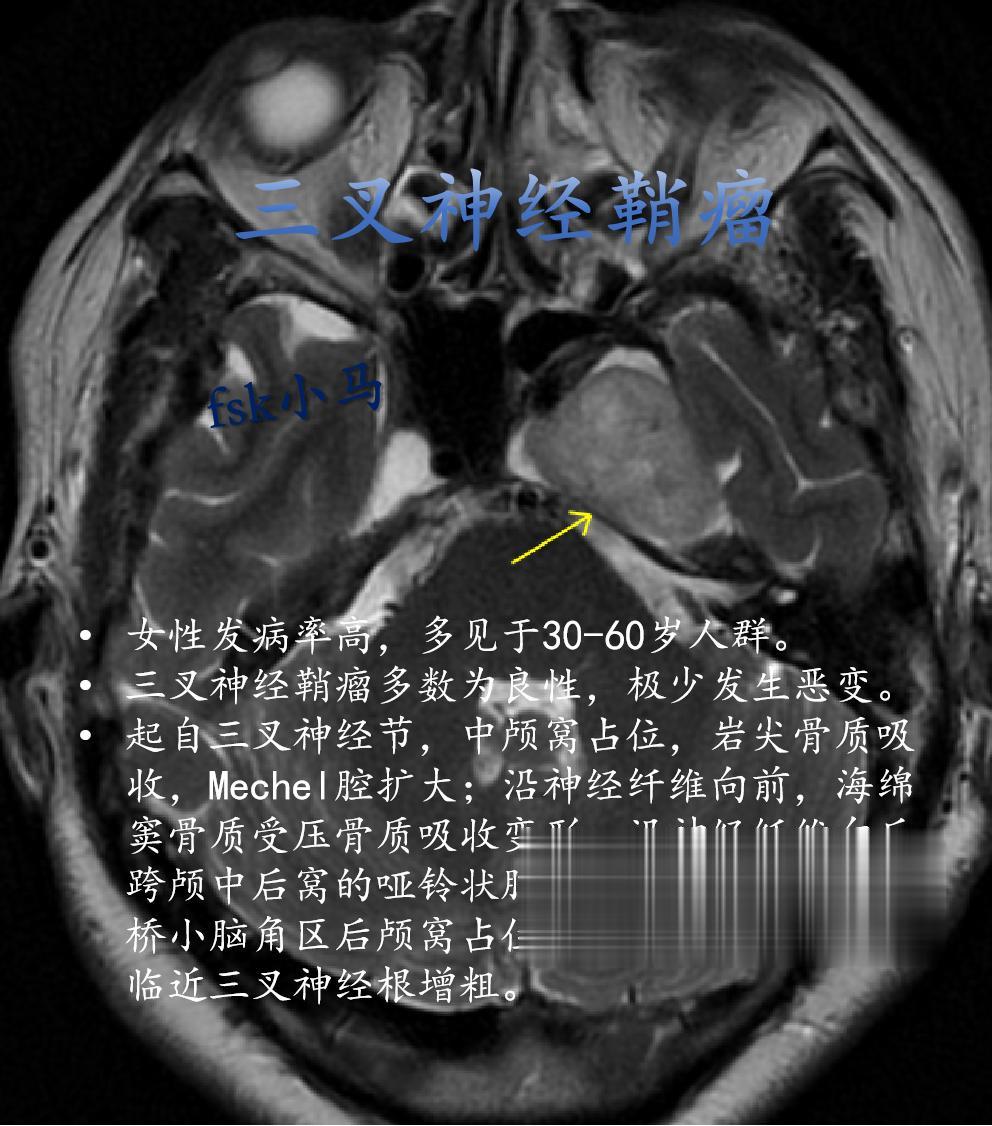 女性发病率高，多见于30-60岁人群。 三叉神经鞘瘤多数为良性，极少发...