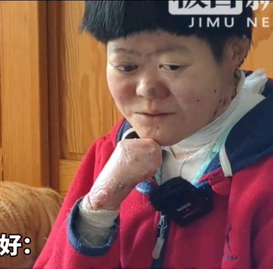 被断言活不过2岁！这个“蝴蝶宝贝”，即将迎来25岁生日
 刚落地就没完整皮肤，右