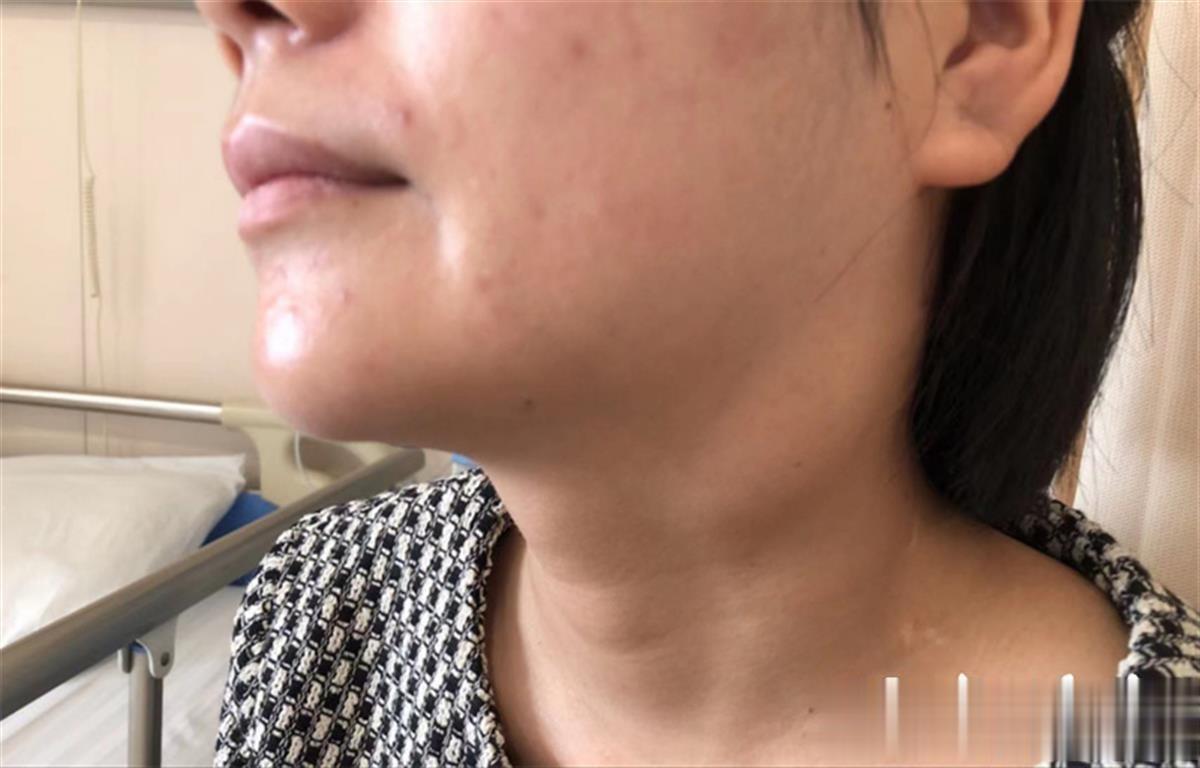 【警惕 接吻病！苏州已经有人中招！】
前段时间有一位女士在医院诊断，医生确诊这位