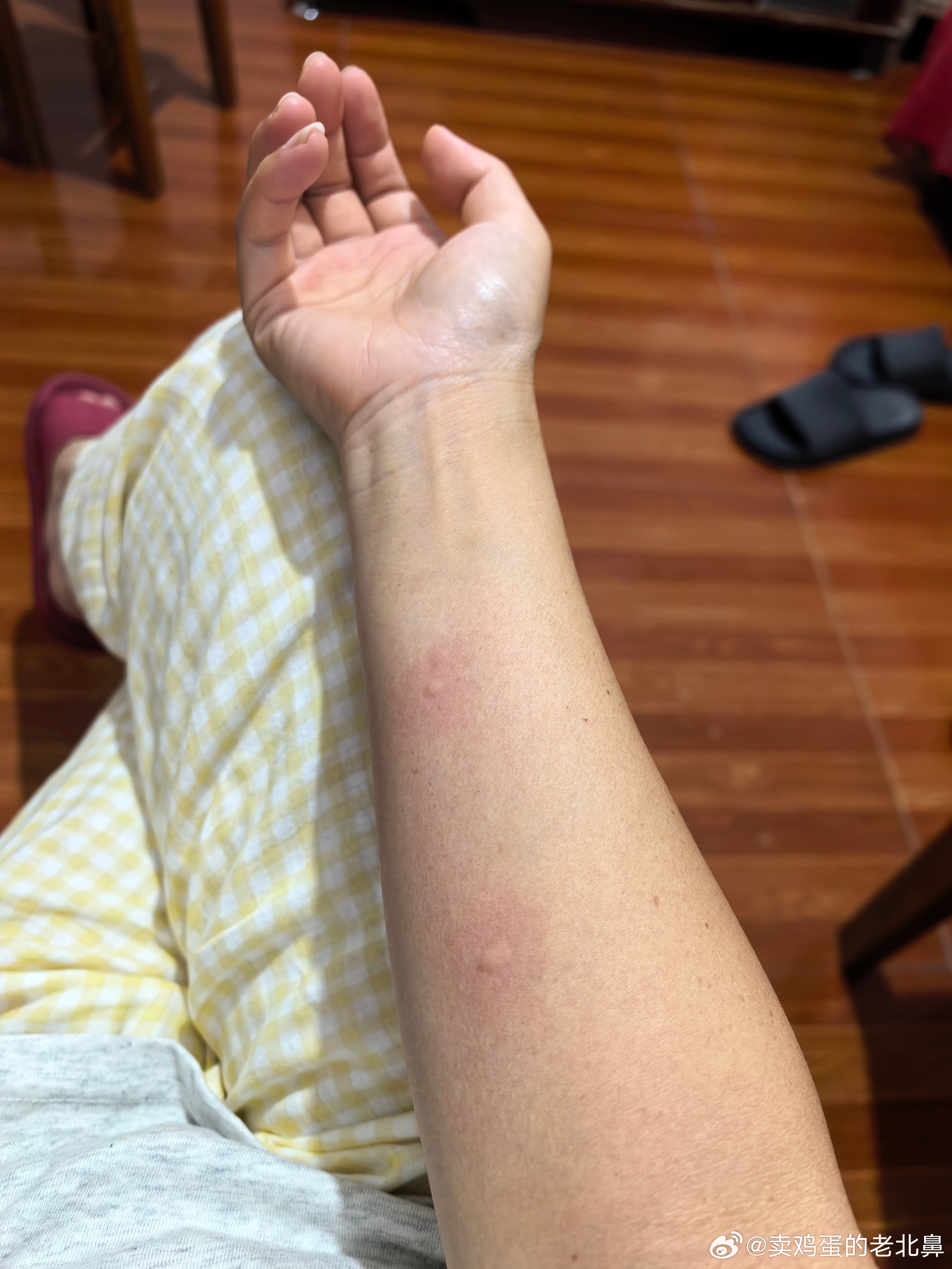 今晚的蚊子怎么这么大这么厉害。脚趾头大拇指给我咬肿了。手臂上咬了三个包。人不留人