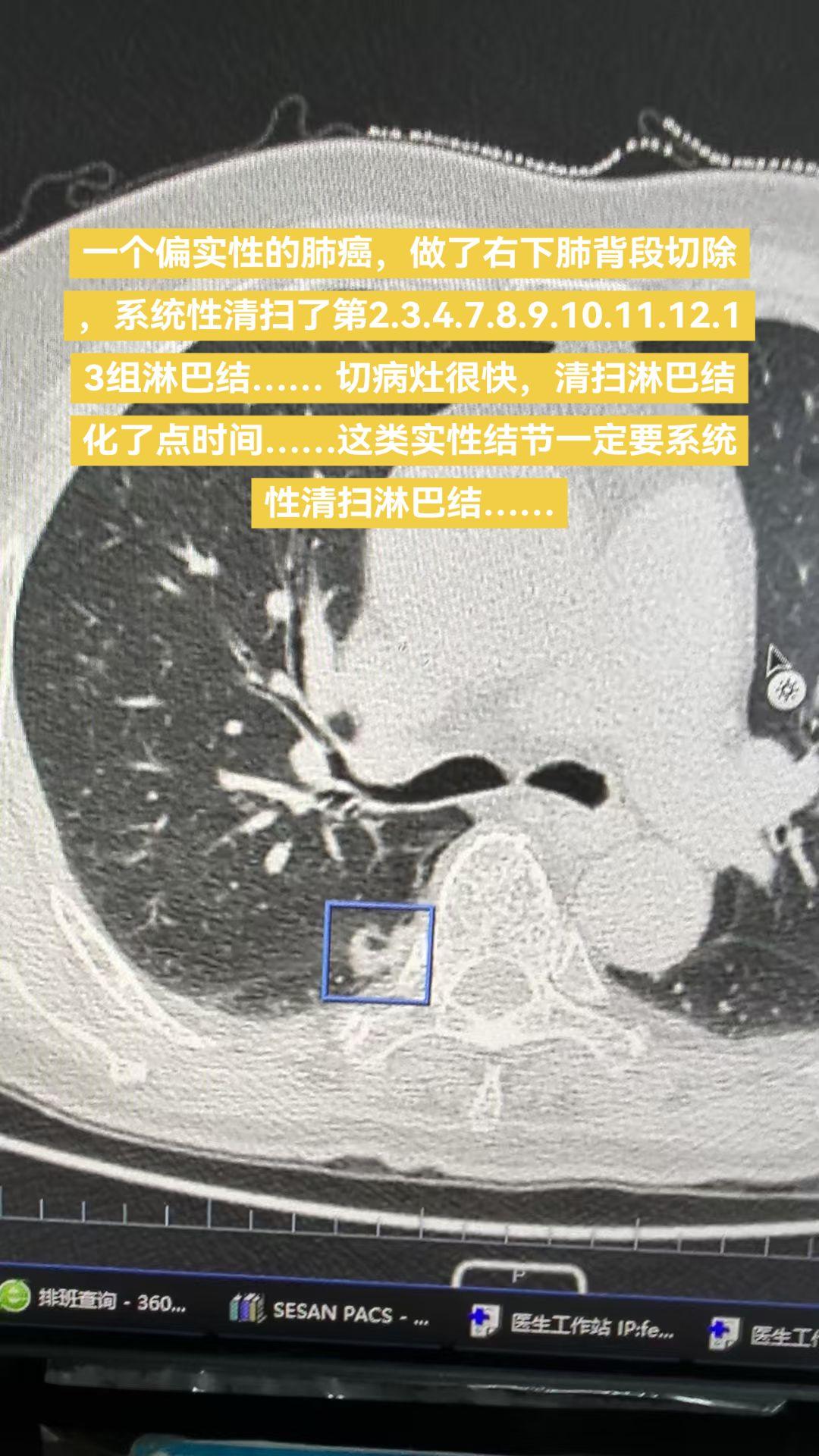 系统性清扫淋巴结。一个偏实性的肺癌，做了右下肺背段切除，系统性清扫了第...