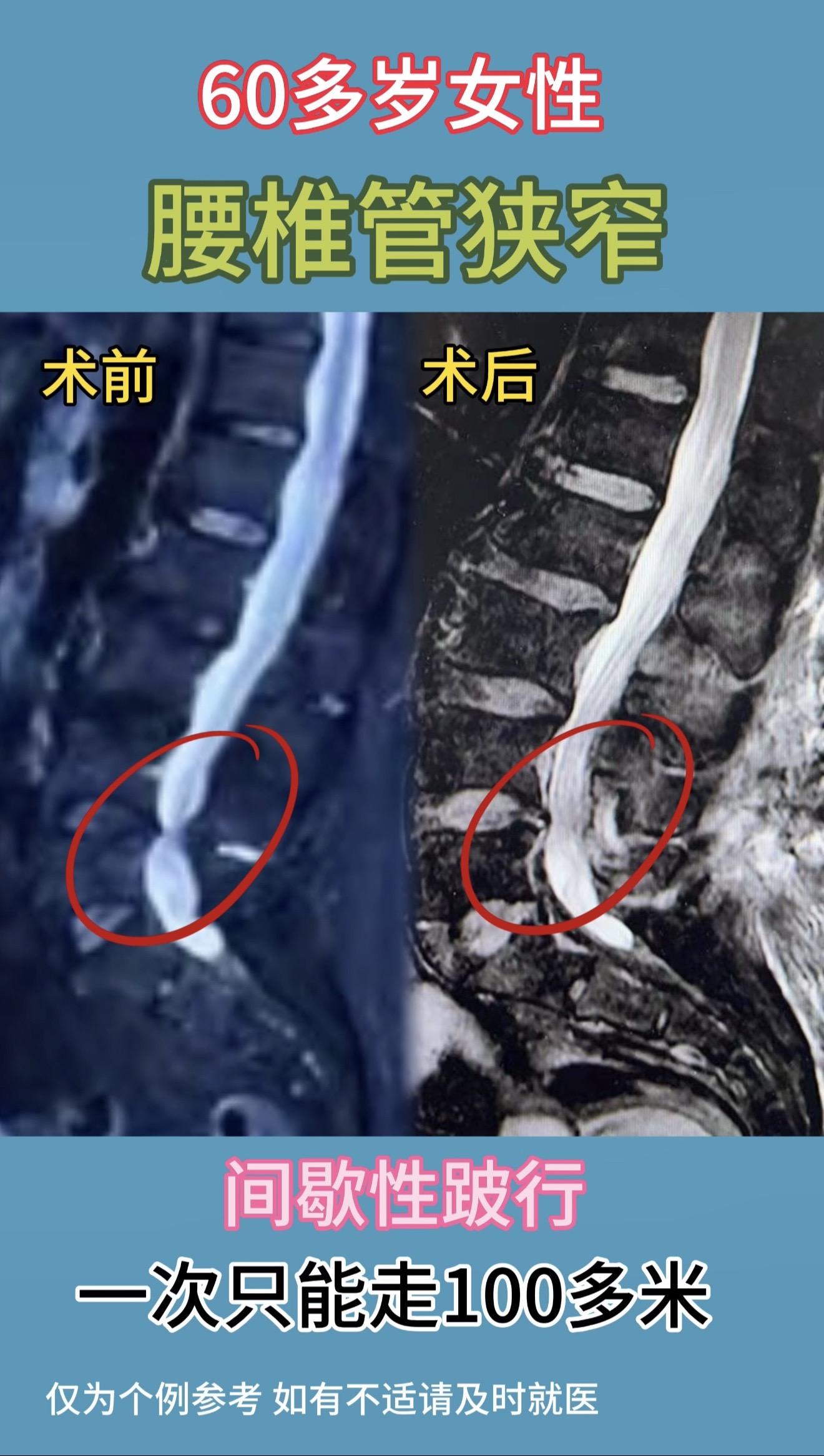 60多岁女性，腰椎管狭窄。术前间歇性跛行，一次只能行走100多米。术后...