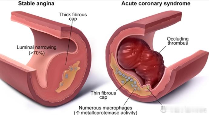 Stable angina Vs Acute coronary syndrome