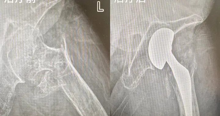 84岁老人意外摔倒骨折 人工股骨头置换术后2天实现站立行走