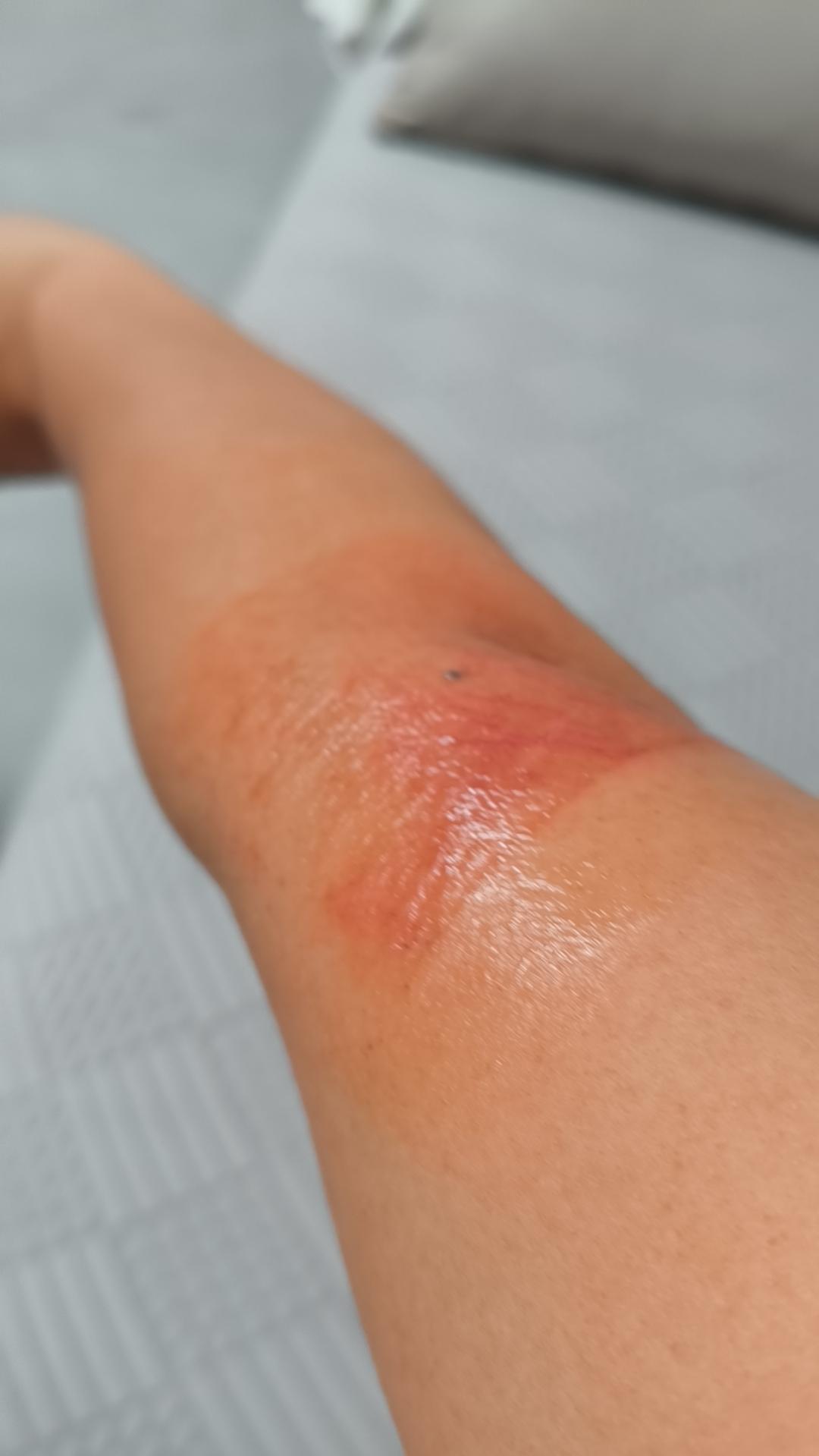 这次出门，离家时还好好的呢，路上不知道咋把右胳膊的筋伤到了，到北京下高铁时，右手