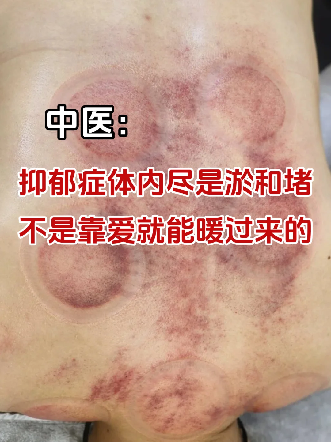 抑郁症，体内尽是淤和堵