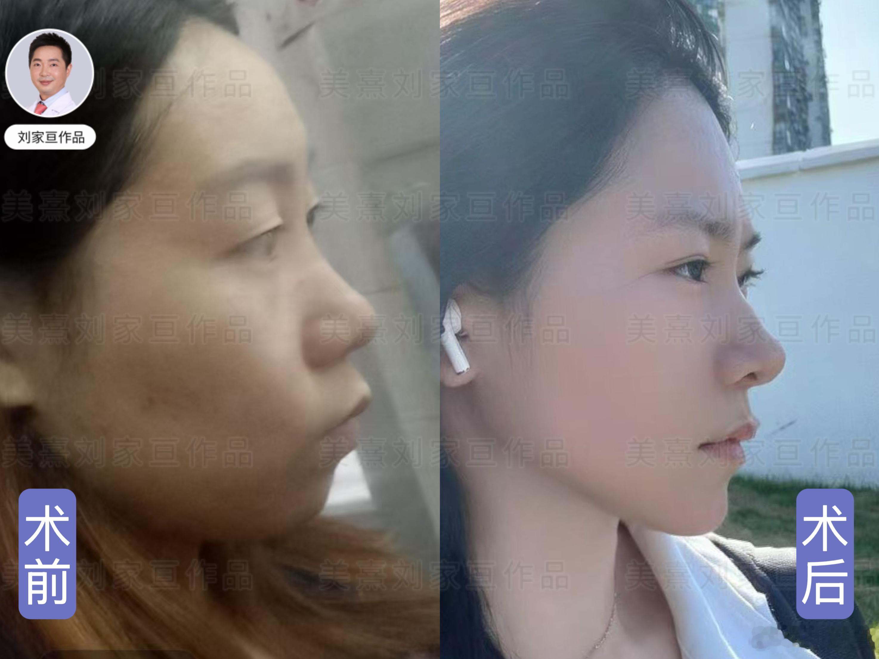 假体垫下巴，术后直面型下巴更显气质好看！ 