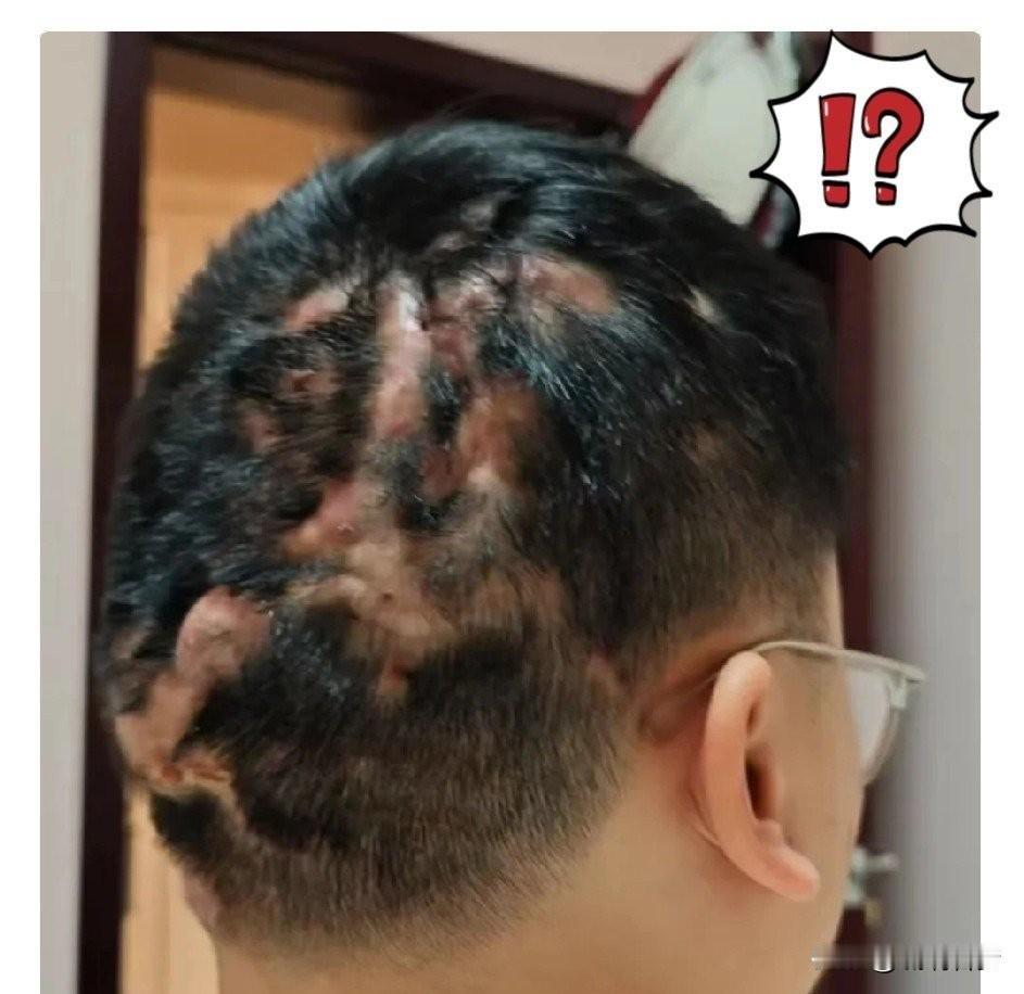 同事儿子21岁就满头脓疮，同事带儿子跑了大半个中国医院，每个医院的医生检查出的结