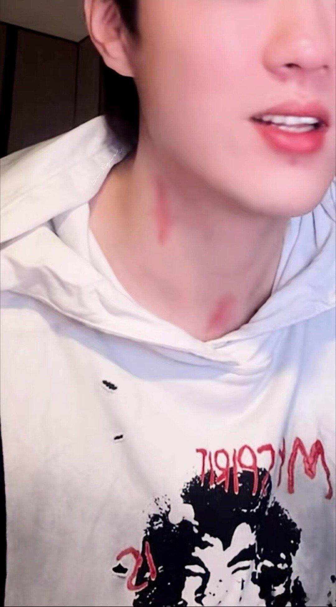 没见过吻痕吗？我亲的，我对象，我对象敏感肌这孩子当着那么多人的面咔咔地把自己划出