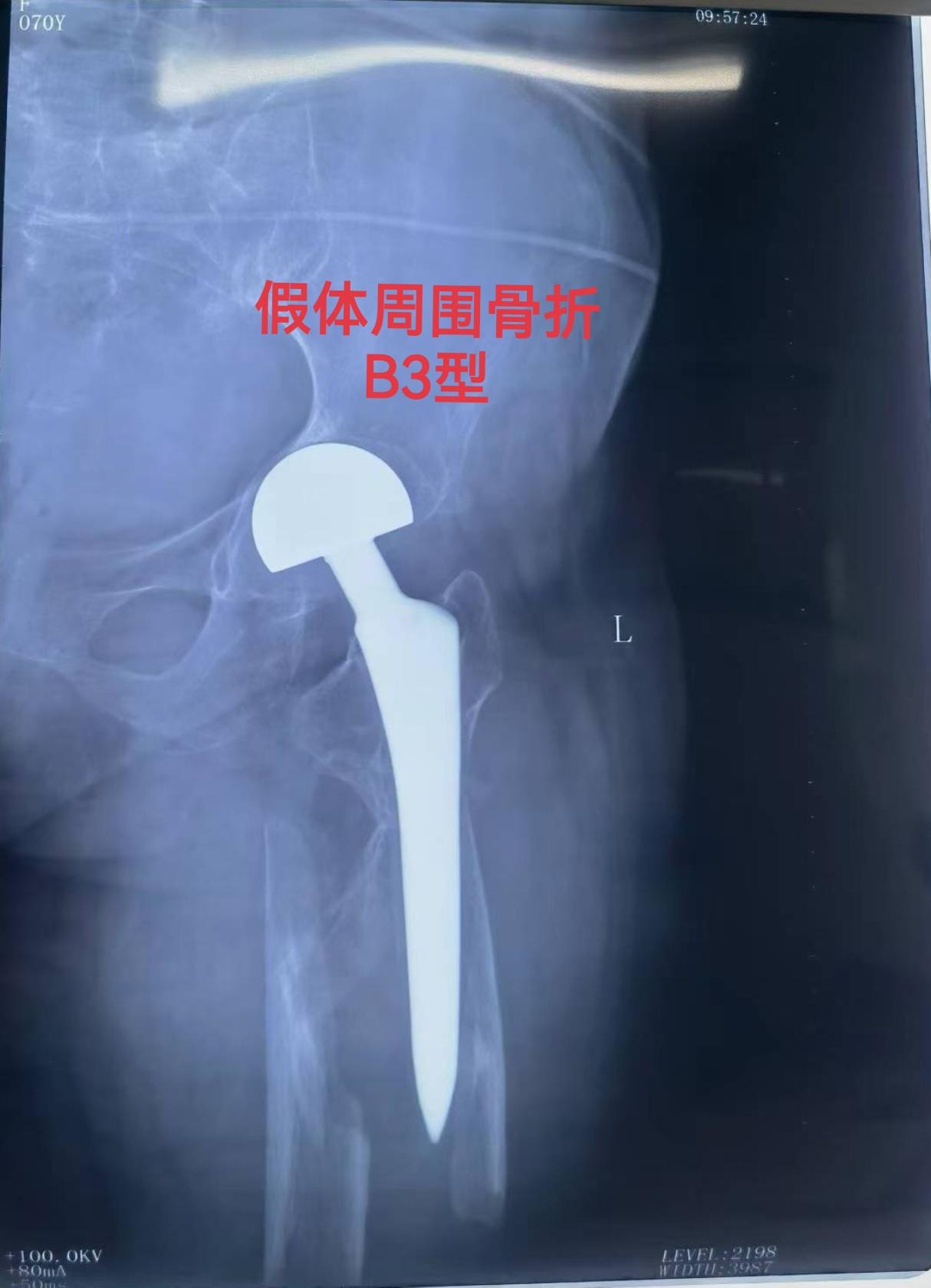 假体周围骨折。髋关节置换术后假体周围骨折，再次翻修，关注老年患者骨质疏...