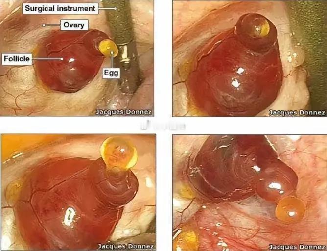 这是人类第一次捕捉到女性卵巢分泌卵子的一幕，太震撼了。
以为这一幕只停留于想象，