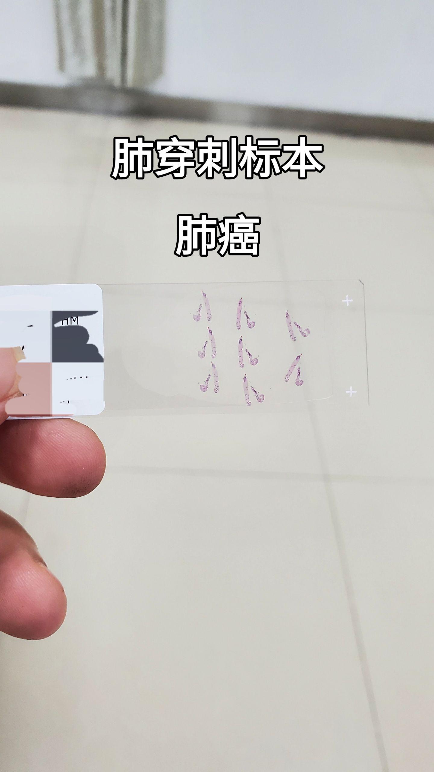 肺穿刺活检 
肺癌