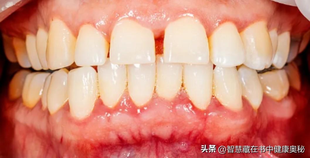 牙齿出血让人烦恼，不过有不少应对和护牙妙招。
刷牙很关键，用巴氏刷牙法，牙刷与牙