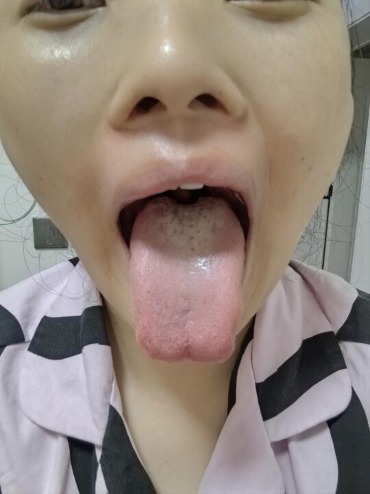 中医哥看我的舌苔，让我戒辣戒冰，我不信