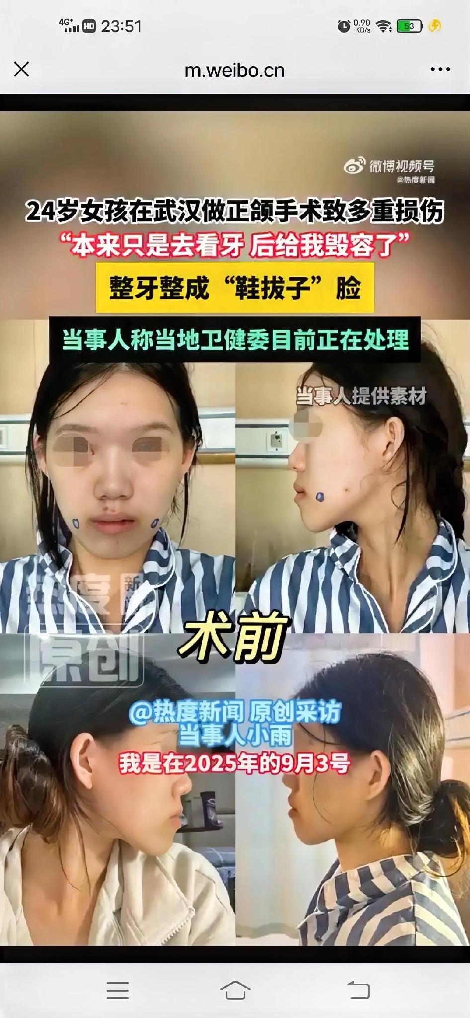 武汉那个小雨姑娘，真是倒了血霉，她原本仅有轻微下巴前突，大概两毫米的幅度，这类情