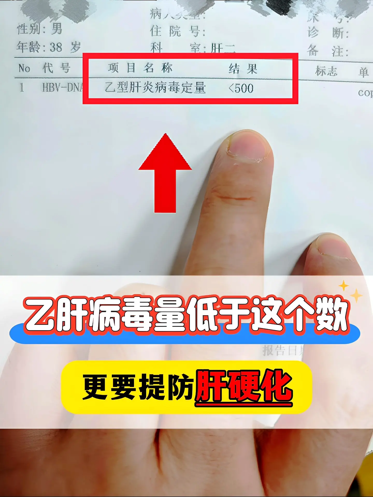 “教授，乙肝病毒定量结果 ＜500IU/mL，是不是不用担心肝硬化了?...