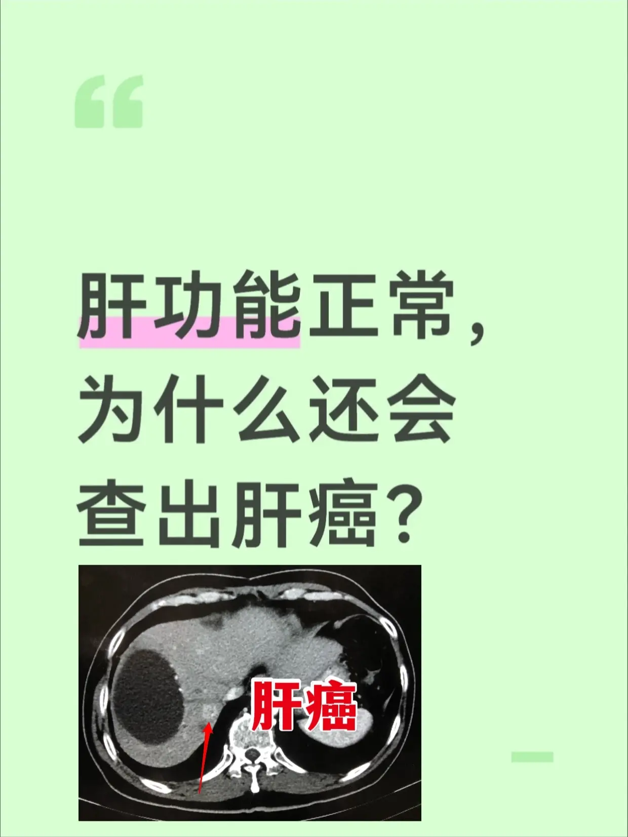 肝功能正常，为什么还会查出肝癌？。很多人都有这个疑问，明明每次体检肝功...