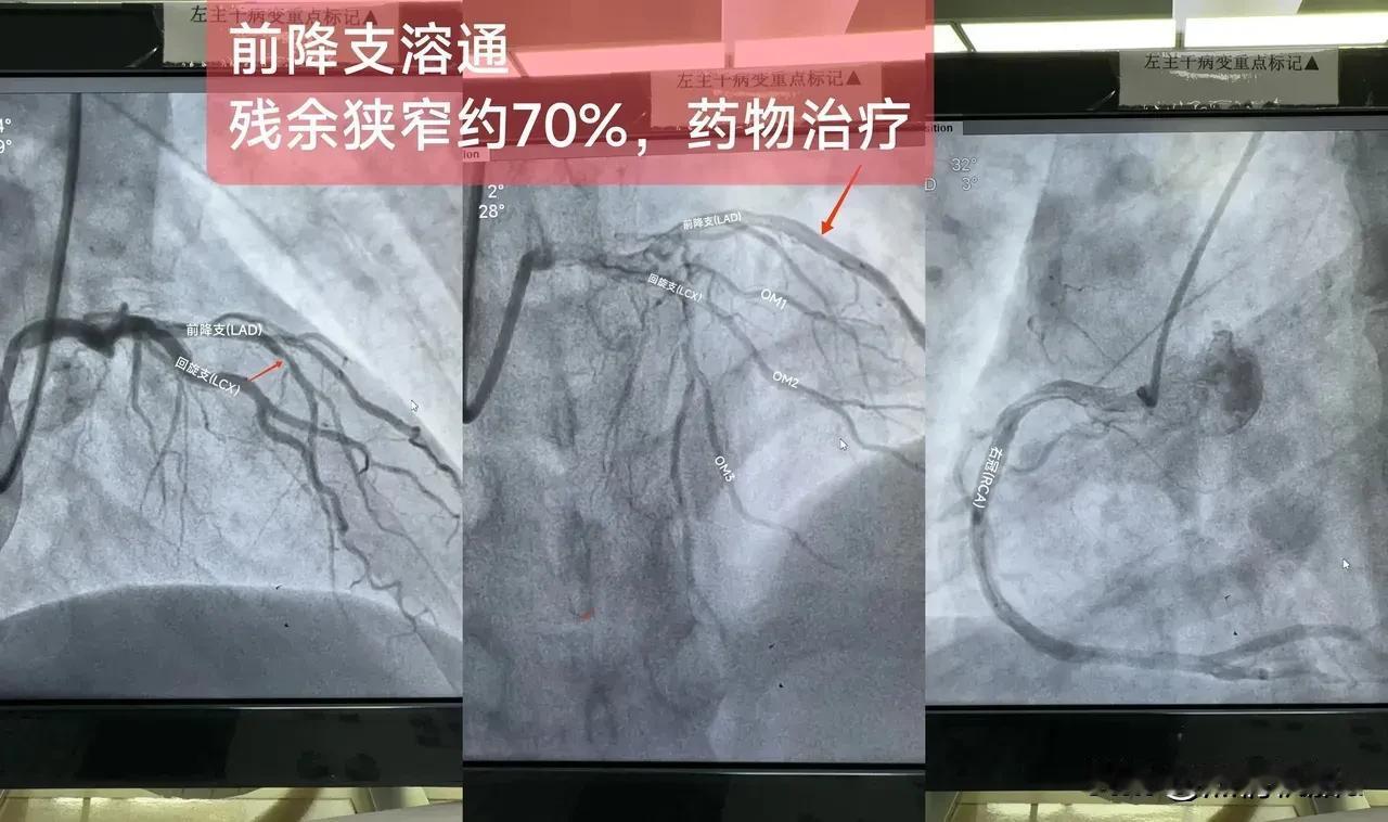 急性ST段抬高型心肌梗死
（前降支溶栓已通，残余狭窄70%，药物治疗)
一.概念