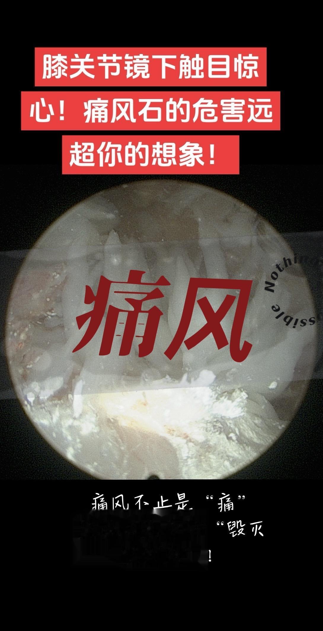 痛风。痛风石“攻占”膝关节！大量痛风石堆积，软骨被侵蚀…… 痛风不止是...