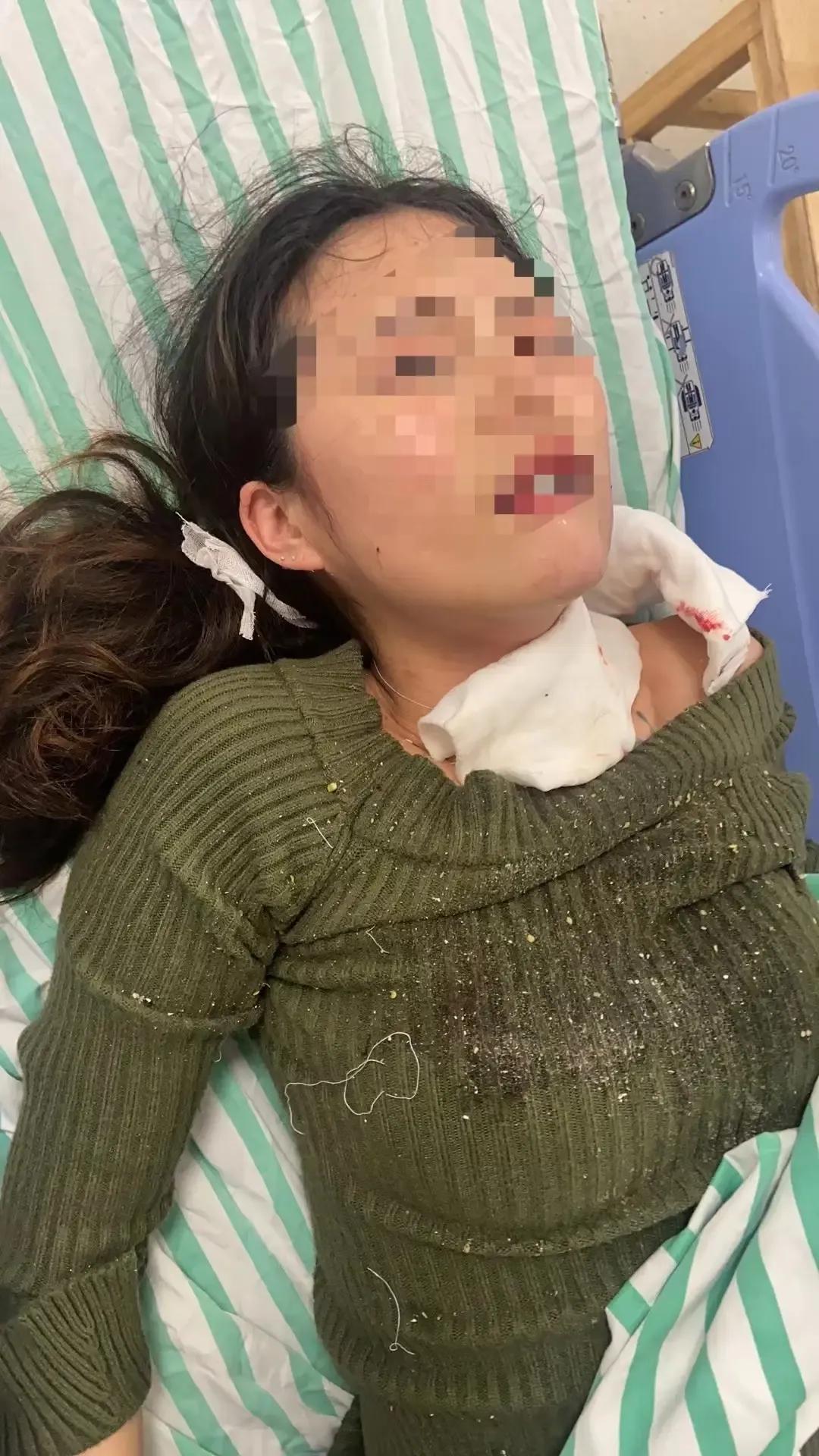 “这就是嘴欠的下场”！一盆滚烫高汤从头顶浇下，28岁温州姑娘林某的面容瞬间被高温