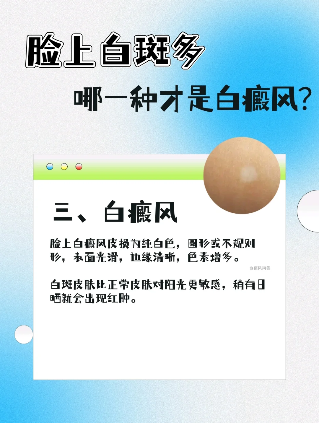 脸上白斑这么多，哪一种才是白癜风❓