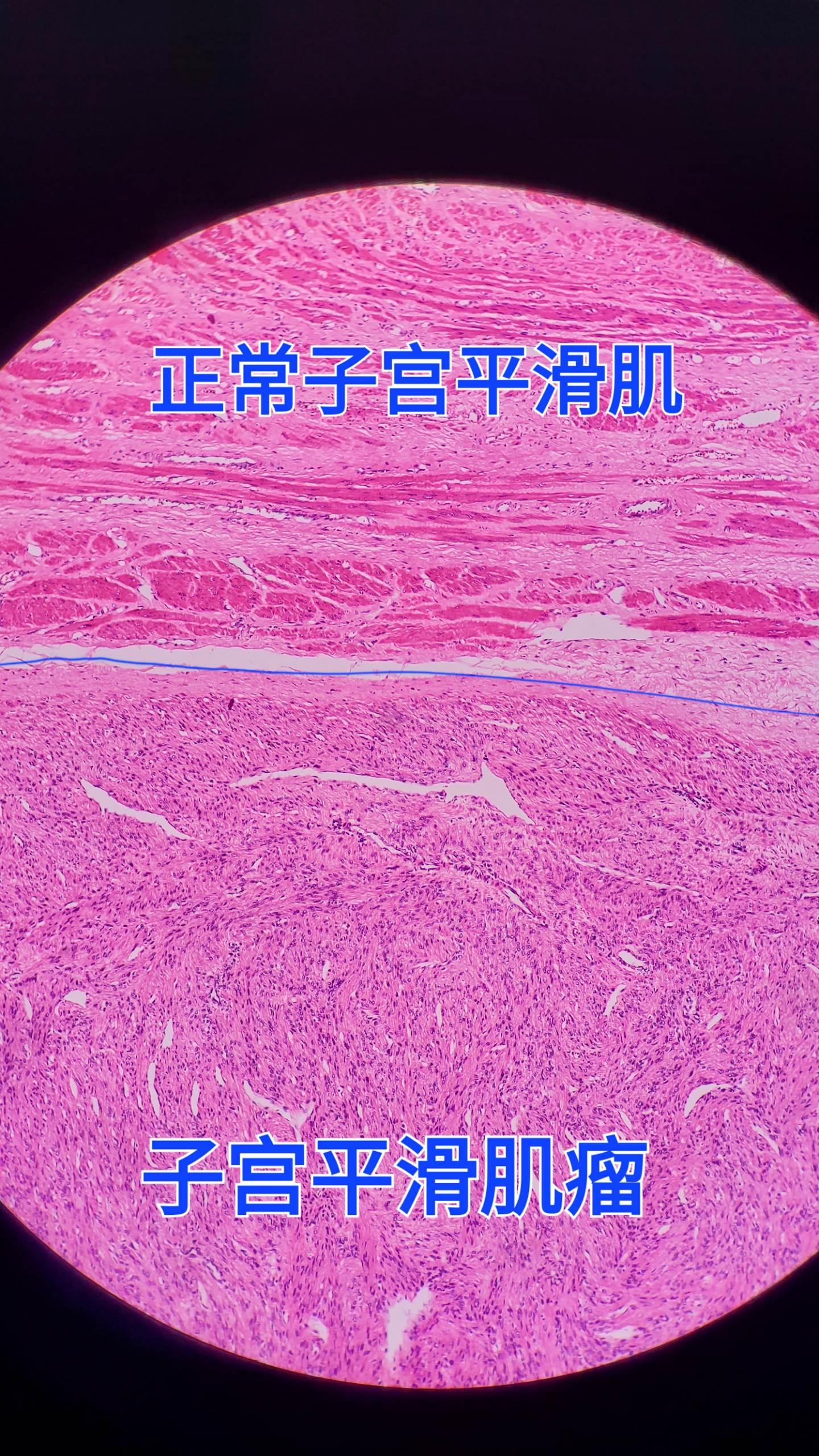 子宫平滑肌瘤