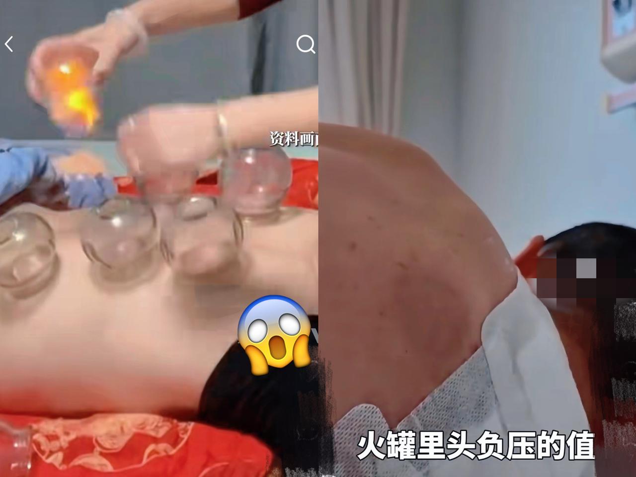 “担心的事情还是发生了！”武汉陈先生腰背疼不看医生，自己判断是湿气重，网购火罐让
