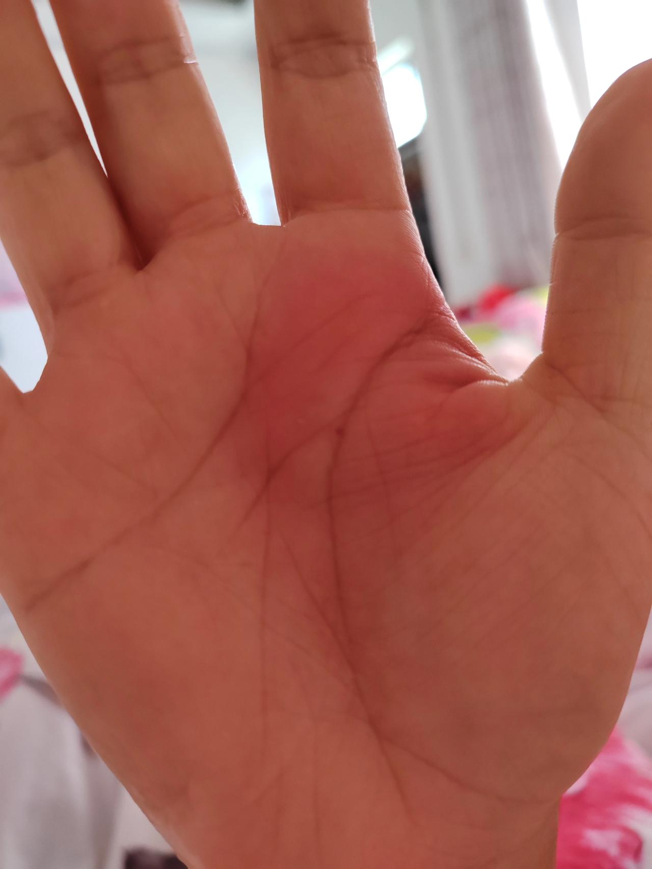 真的好倒霉啊，头几天被蜜蜂蛰着手，第二天结婚纪念日骑电动车带着孩子车翻了，自己又