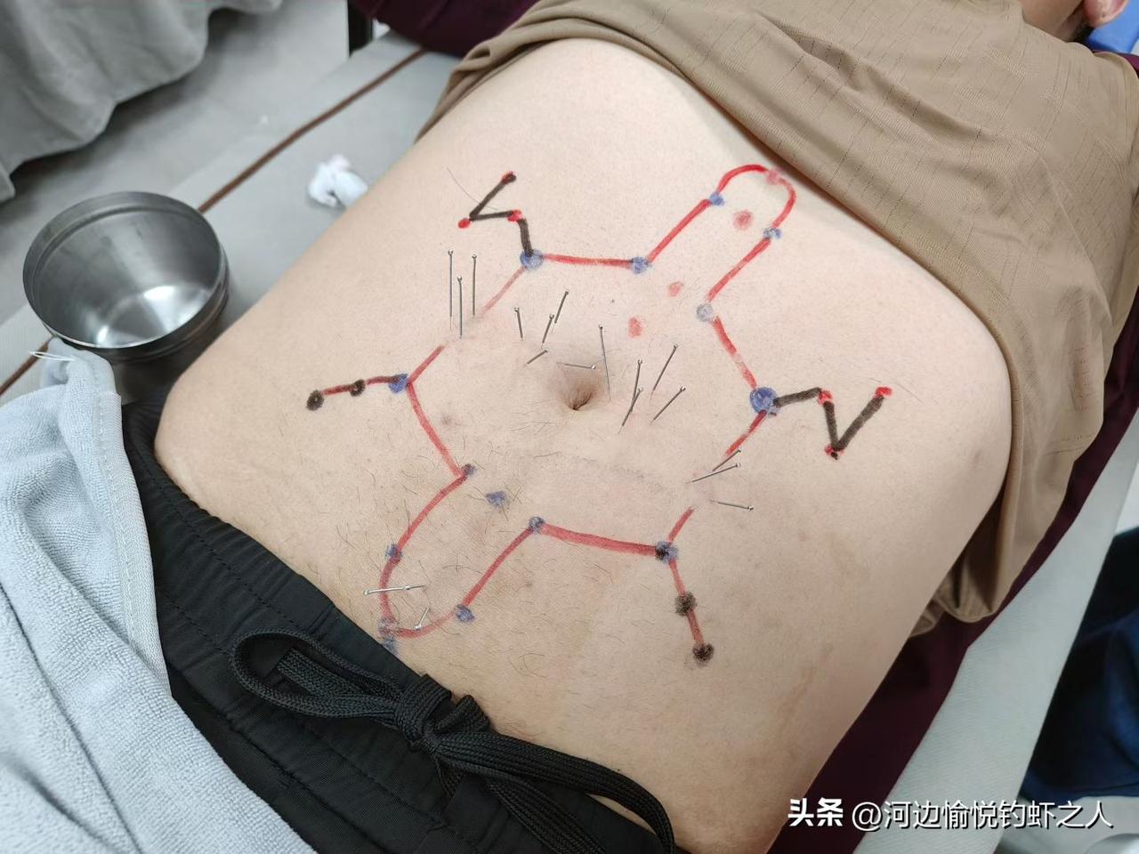 灵骨穴 + 大白穴（手背）
- 最神之处：腰腿痛克星（特别是坐骨神经痛），也是治