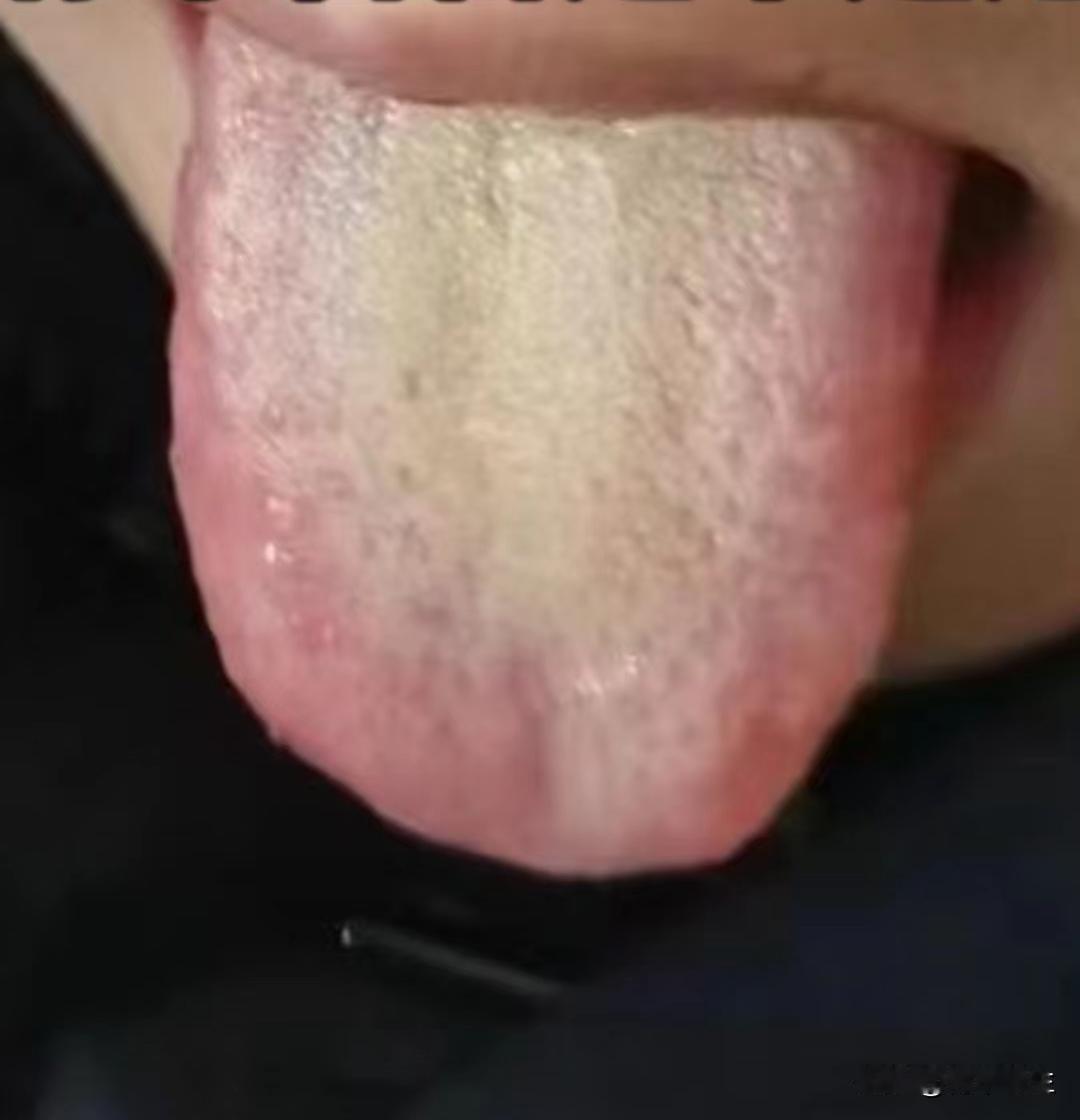 咳嗽不停有两个原因，别只会止咳，要不然越治越咳嗽，辨证论治才是真理

今天正好有