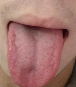 又碰到这种上热下寒的舌头了，太令人头疼了！
说这种情况难调理吧，它也不难，可为什