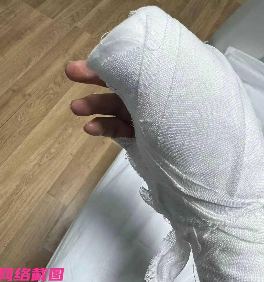 内蒙古有男子网购一把美工刀，却发生意外，因拆快递反而被内有刀片割伤手掌。

之后