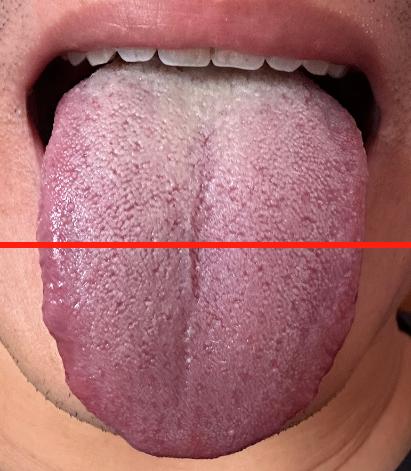 【舌诊分析】大哥真不拿身体当回事，身体都造成上热下寒了！

你看这个舌象，就属于