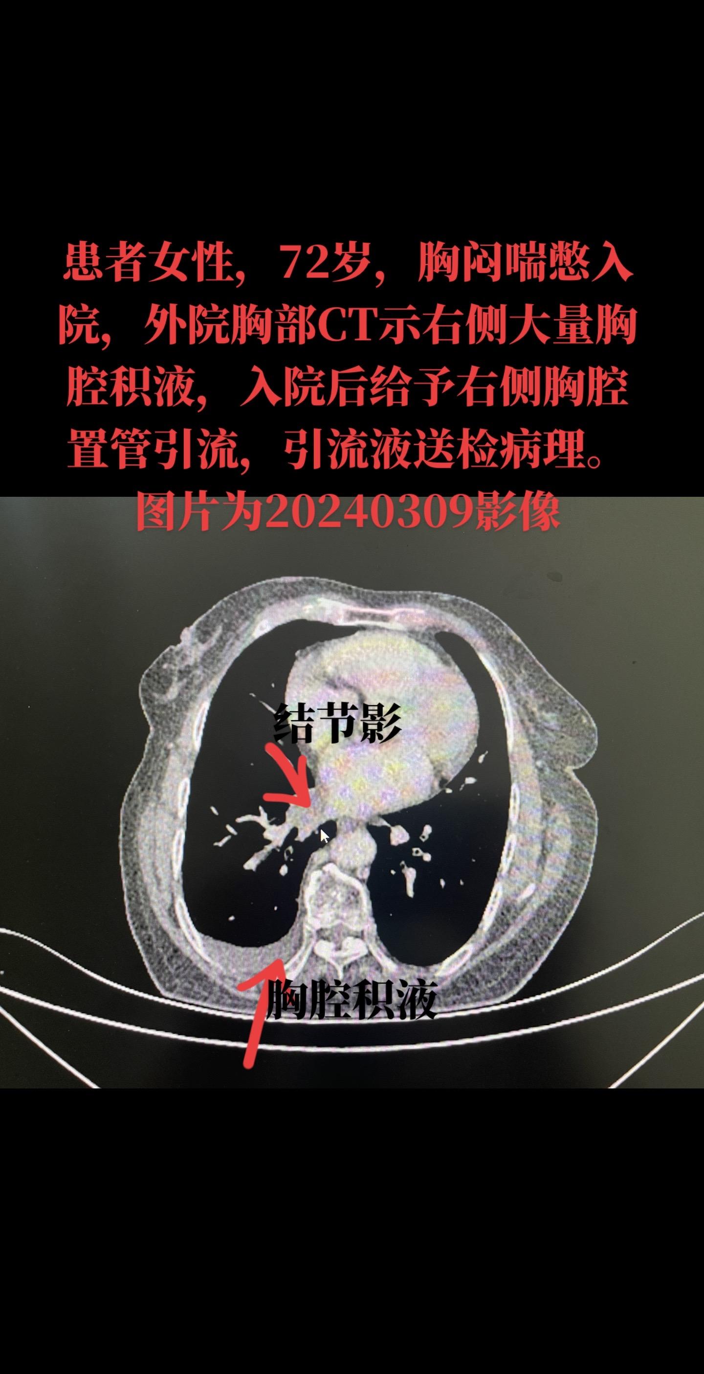 病例分享：右肺下叶腺癌、右侧恶性胸腔积液，胸水病理提示腺癌，建议患者行基因检测，因穿刺活检风险高，采用胸水病理+血液基因检测的方法，行基因检测。待结果回归后行下一步治疗方案。