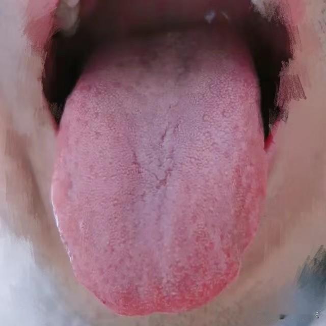 下焦湿热，血热生瘀，心火亢盛
 
舌根腻成这样还在吃肾气芄？小心越吃越功能越差！
