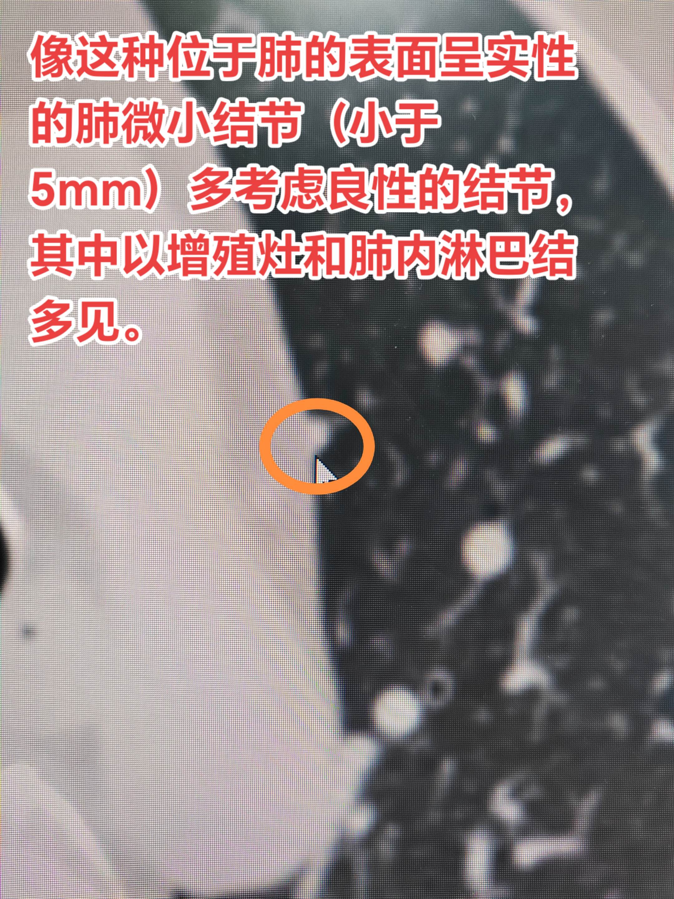 发现微小实性结节如何应对？像这种位于肺的表面呈实性的肺微小结节（小于 ...