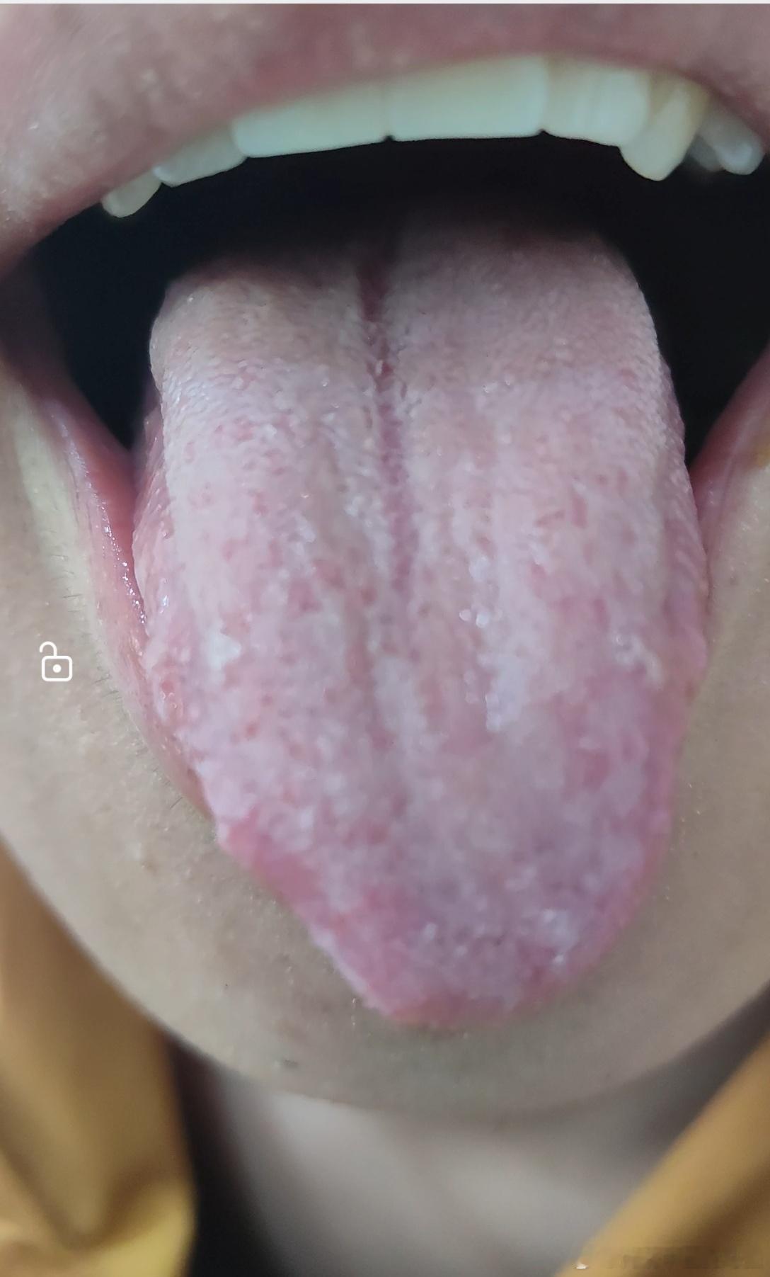 二十多岁的老胃病患者最近各种胃病患者突然多了起来下午来了个胃胀的患者才23岁，从