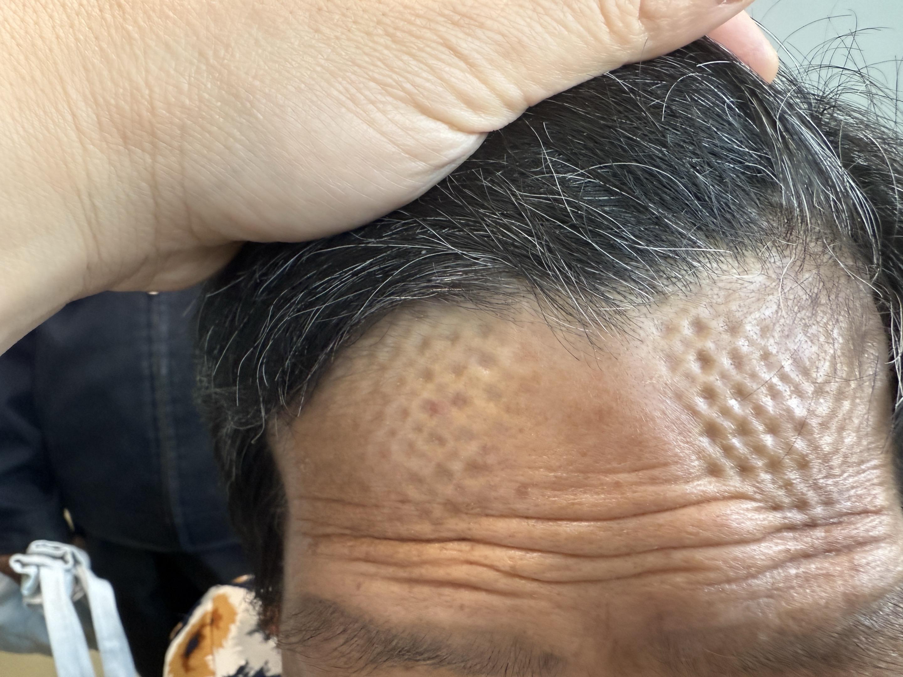 颅骨修补之钛网。外院颅骨修补10年，出现皮肤内陷，钛网材料外形显露，这...