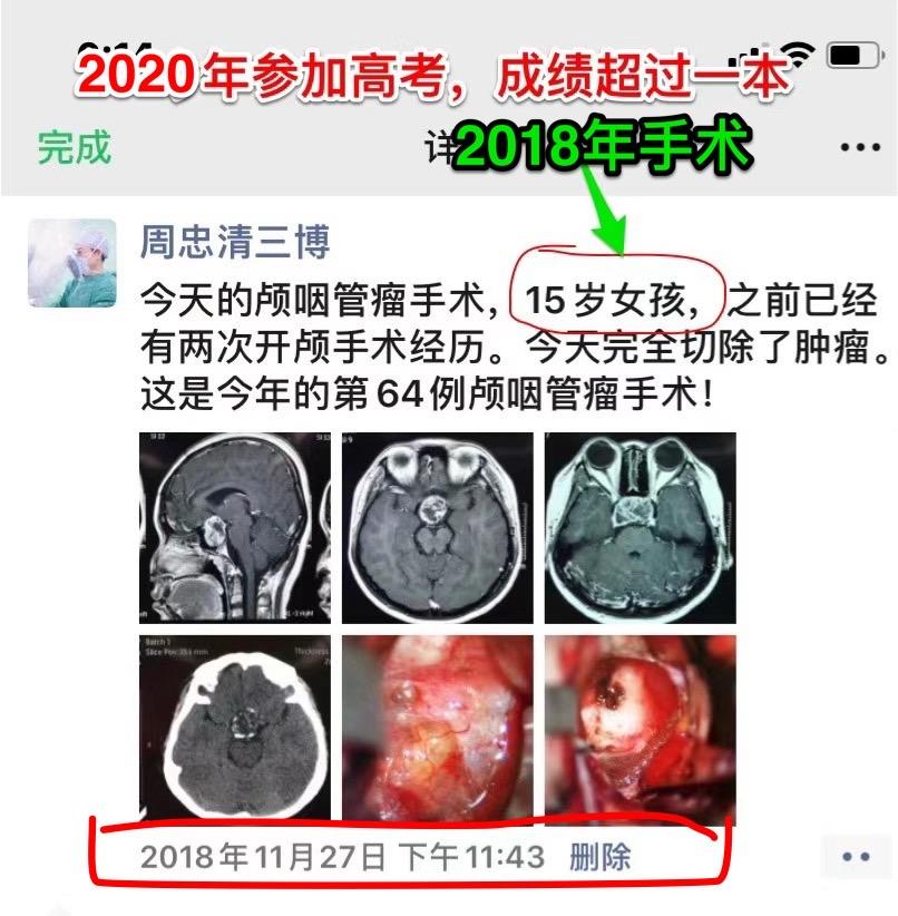 颅咽管瘤患者经历三次手术考上研究生。2018年11月27日在我科作颅咽...