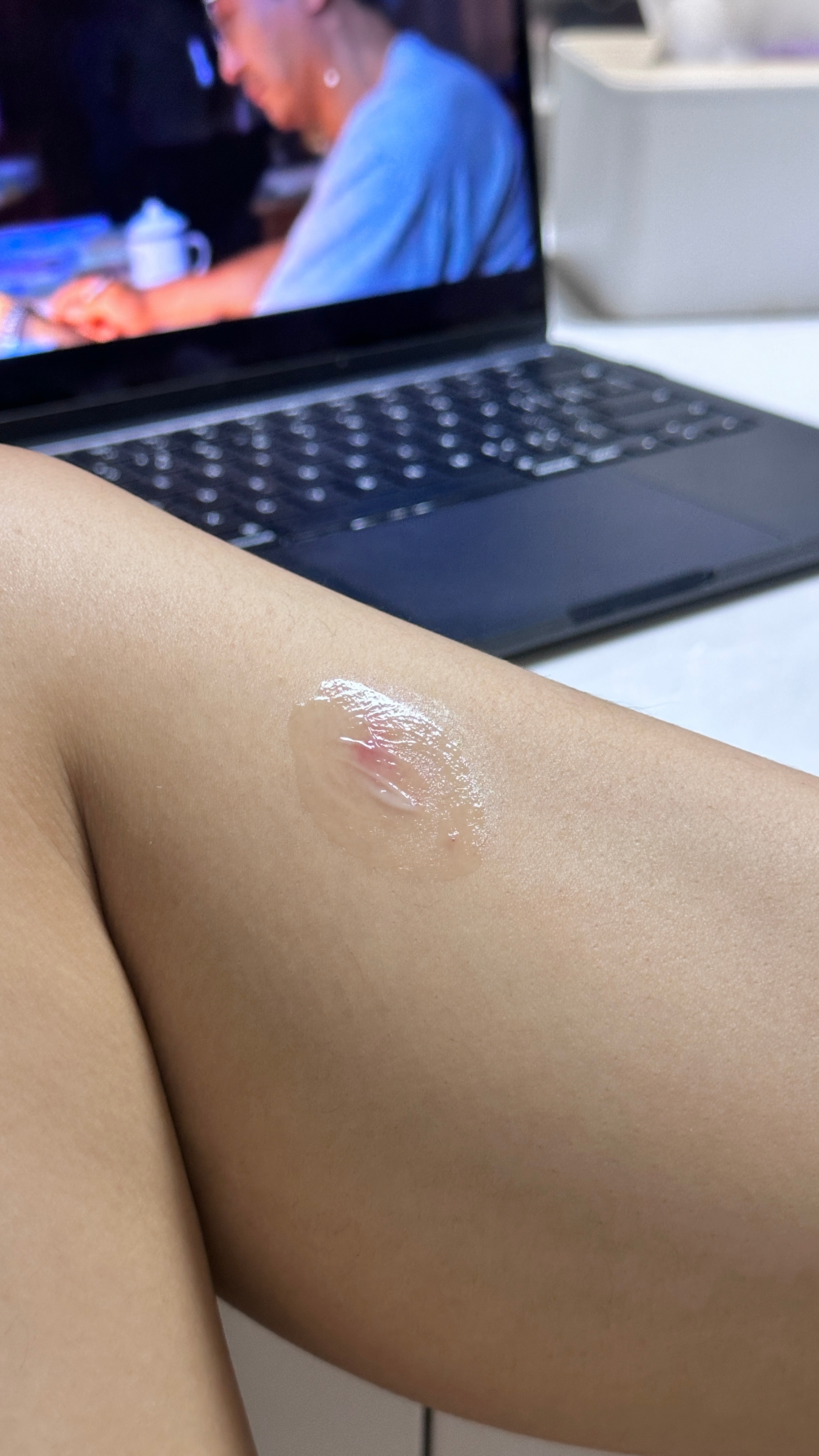 蚊子把我腿咬成这样啥意思！！！！ 