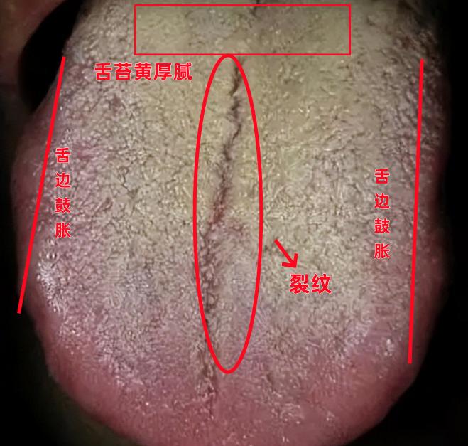 35岁小伙天天大腿根潮湿，时间短，吃药反而越严重，一问每天都在用手！这样再怎么补