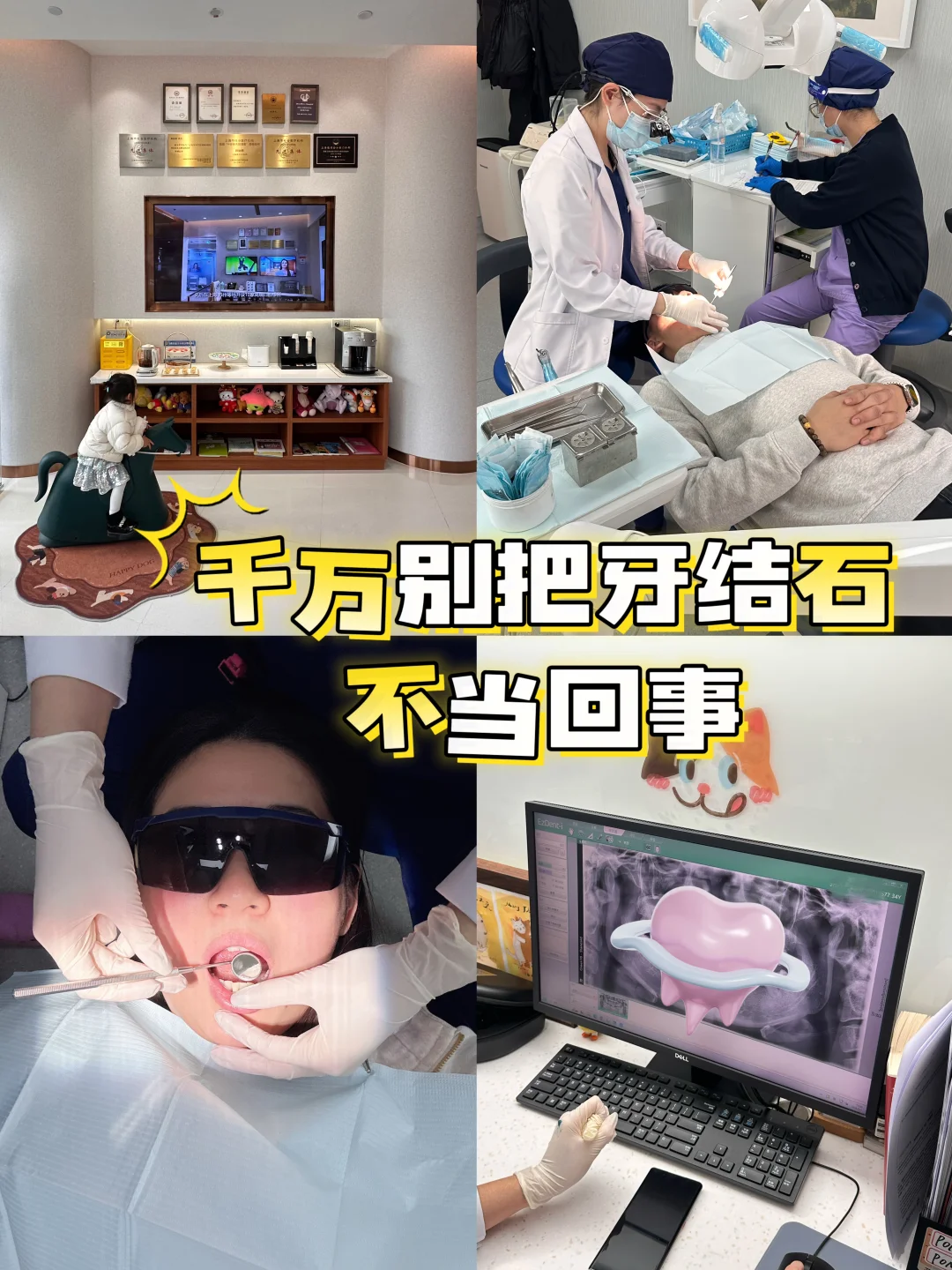 和牙结石说拜拜 给牙齿🦷做个大清洁🧹啦