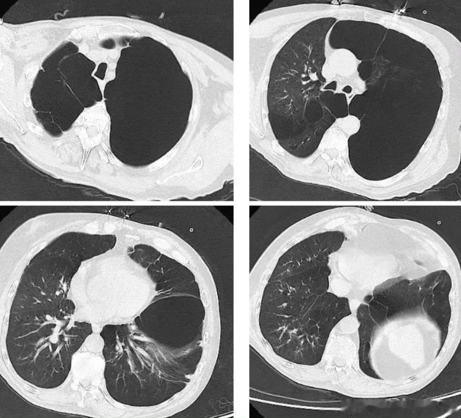 #戒烟# 男性，56岁，抽烟30余年，导致重症肺大泡肺气肿，尤其左肺大泡占据左侧