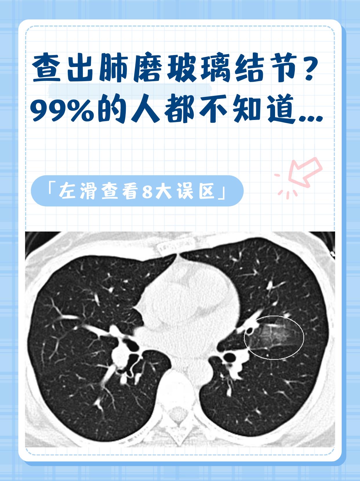 查出肺磨玻璃结节，99%的人都不知道的8件事