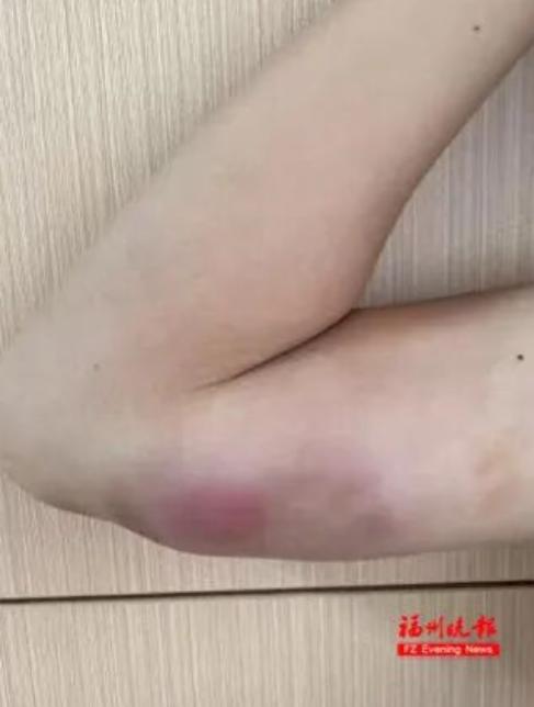 这下后悔了吧！福建福州，一13岁男孩好心喂流浪猫，没想到，胳膊上竟冒出拳头大的疙