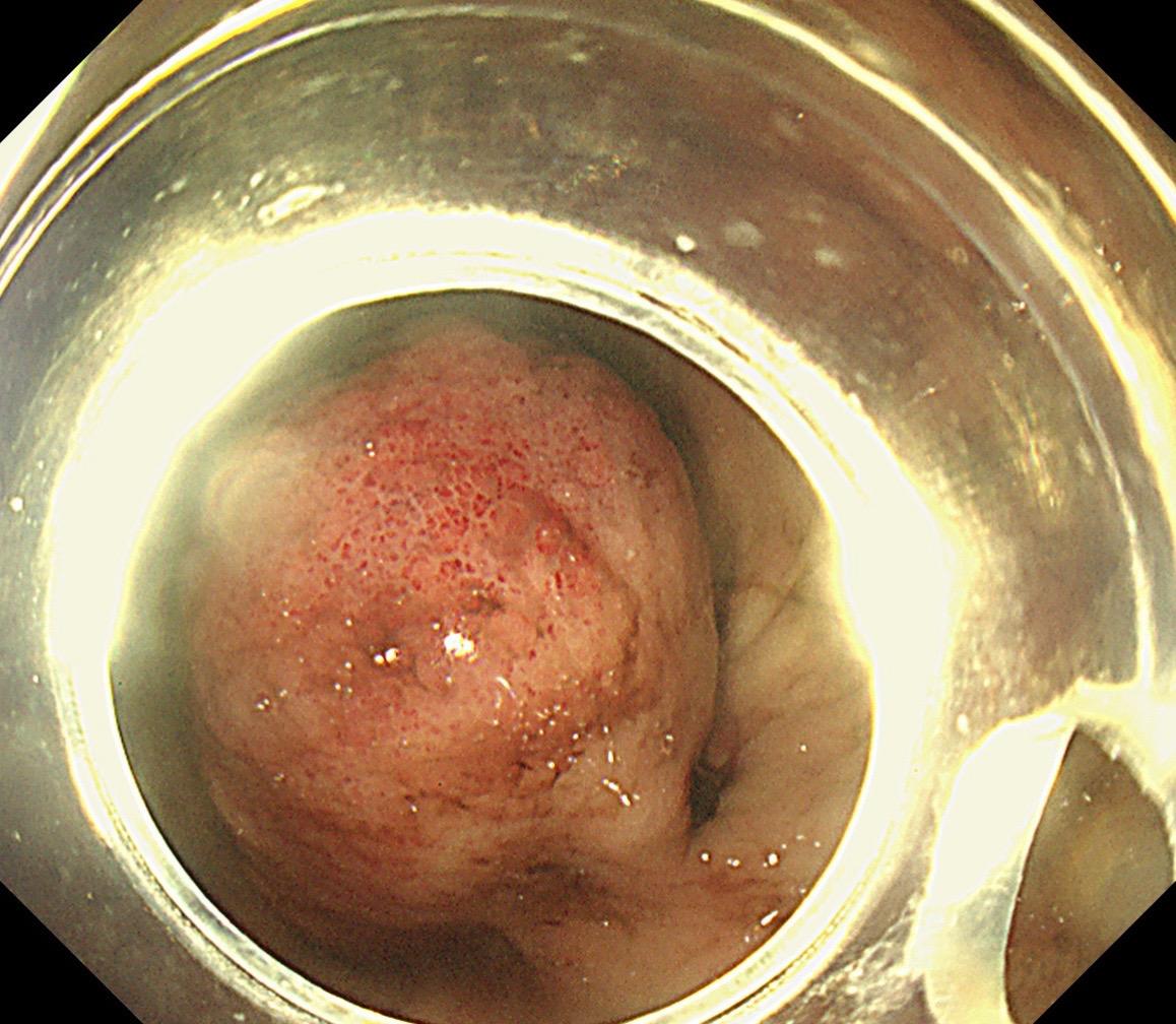 间质瘤需不要手术？这个大出血就很能说明！老年患者，急性消化道出血失血性...